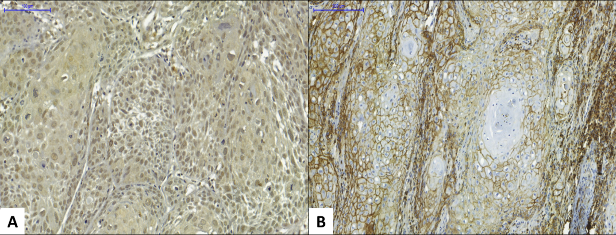 The role of OCT4 and CD44 in lower lip carcinogenesis