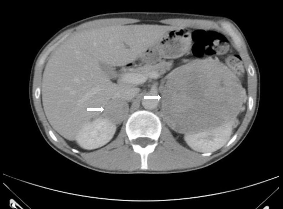 Approach to Endocrine Hypertension: A Case-Based Discussion