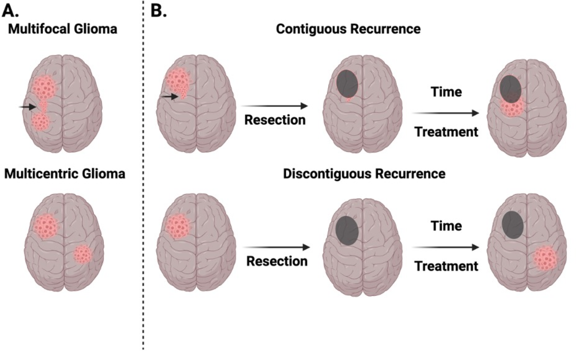 Discontiguous recurrences of IDH-wildtype glioblastoma share a common origin with the initial tumor and are frequently hypermutated