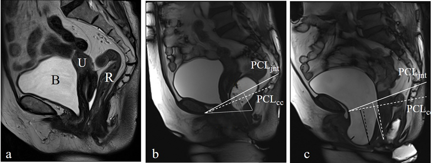 Assessment of Different Pubococcygeal Lines for the Quantitative Diagnosis of Pelvic Organ Prolapse Using Magnetic Resonance Defecography