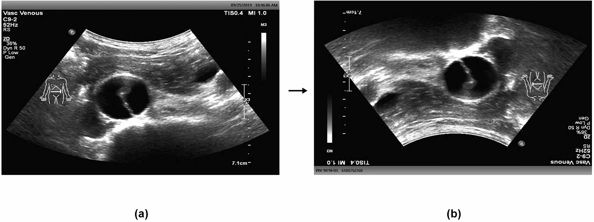 Deep learning-aided diagnosis of acute abdominal aortic dissection by ultrasound images