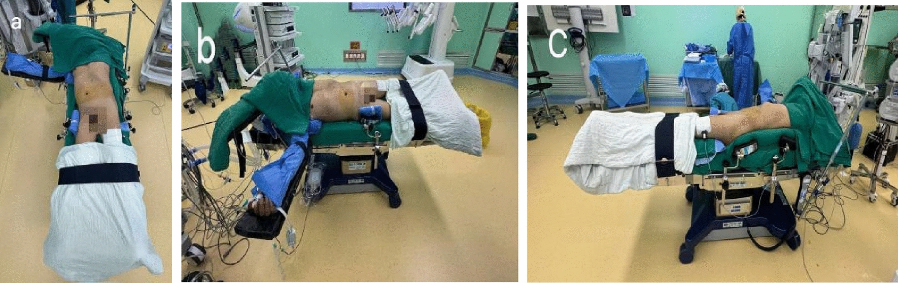 Improved positioning in robotic assisted laparoscopic partial nephrectomy using the EDGE MP1000 surgical robot