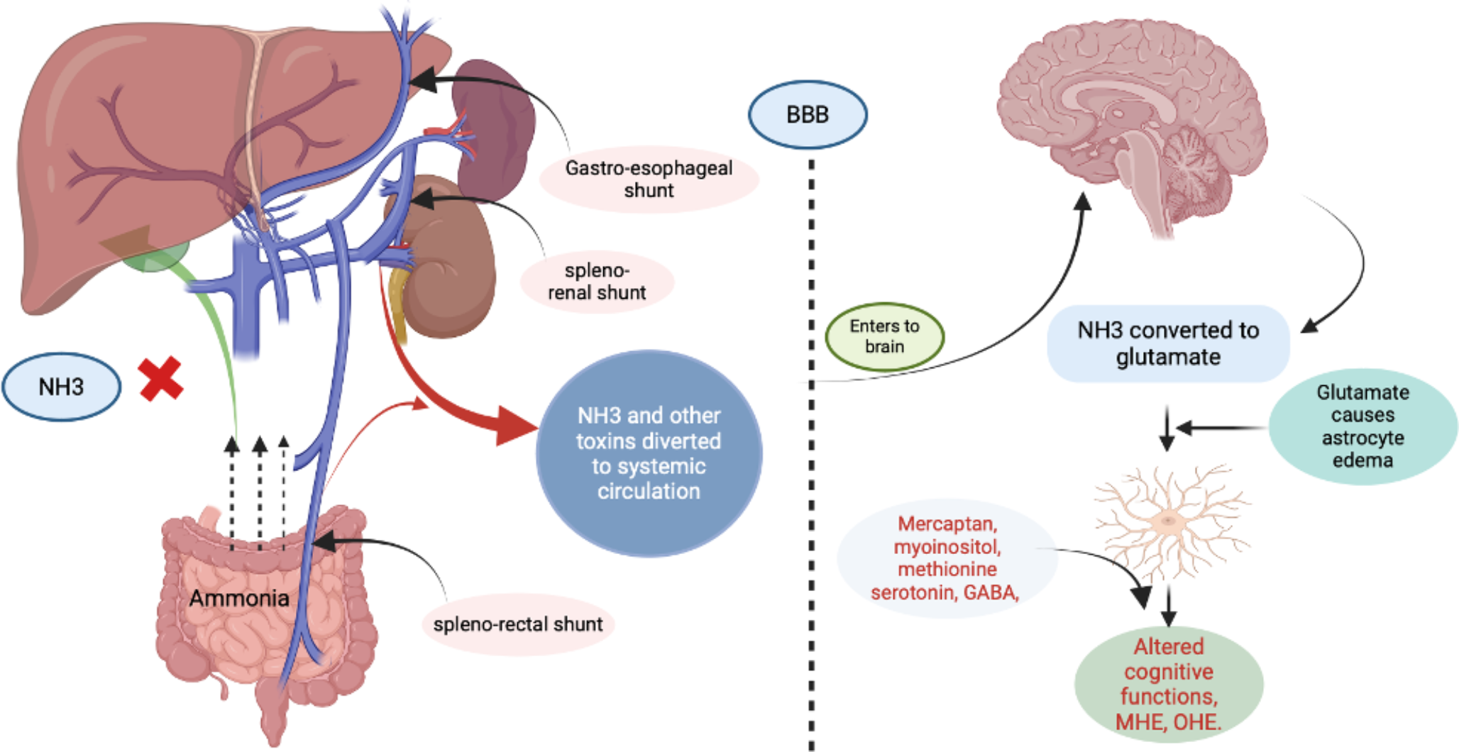 Hepatic encephalopathy in non-cirrhotic portal hypertension