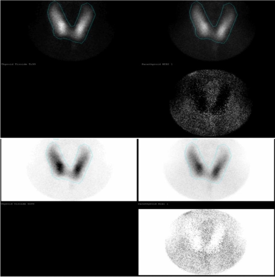 How has the diagnostic approach to parathyroid localization techniques evolved in the past decade? Insights from a single-center experience