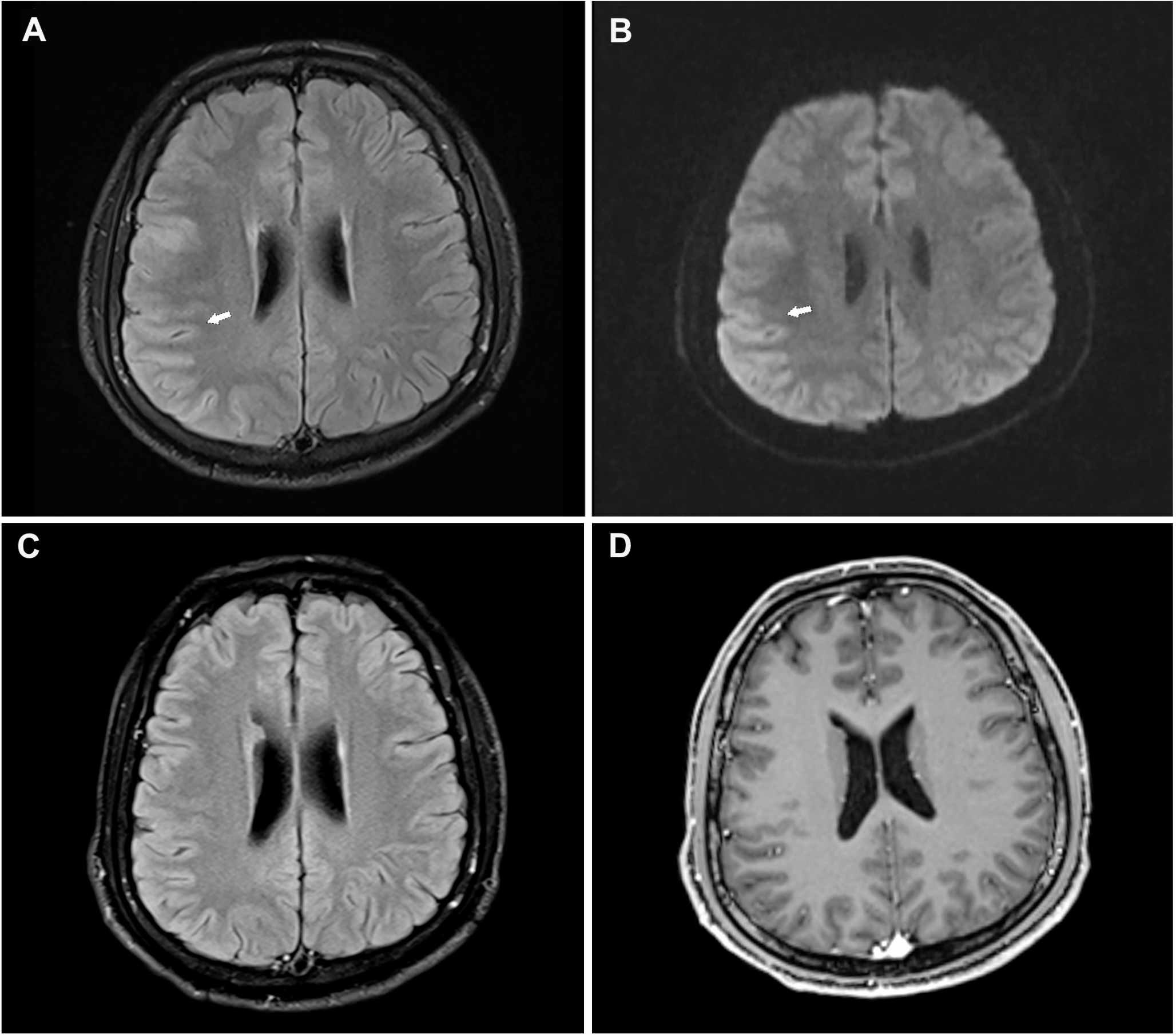 Efgartigimod treatment for therapy-refractory autoimmune encephalitis with coexistent NMDAR and LGI1 antibodies: a case report and literature review