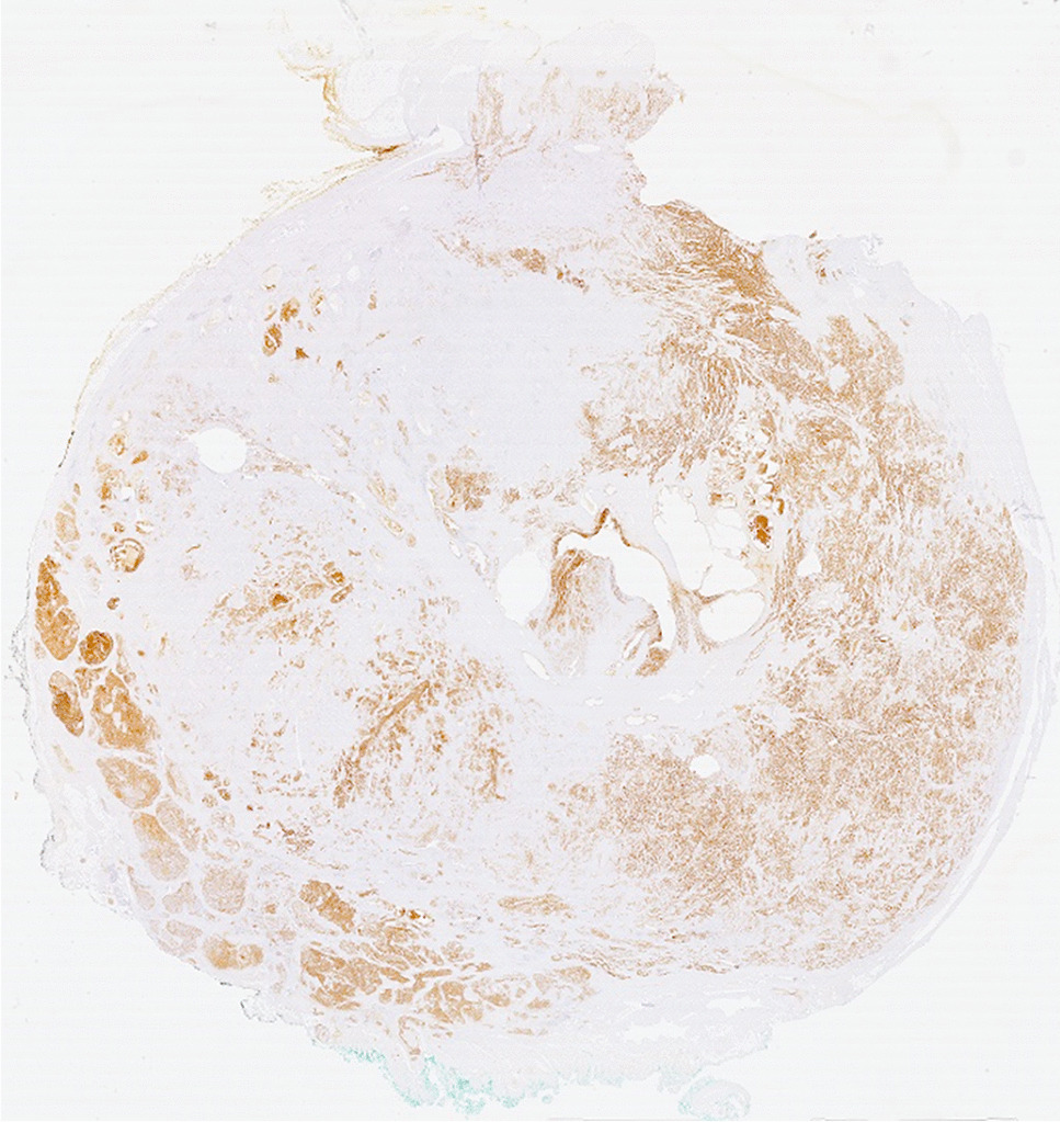 Can PSMA PET detect intratumour heterogeneity in histological PSMA expression of primary prostate cancer? Analysis of [68Ga]Ga-PSMA-11 and [18F]PSMA-1007