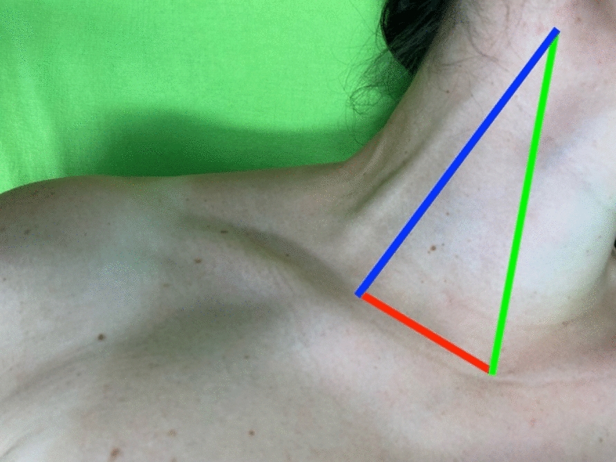 A novel “lateral approach short axis in-plane” technique vs. conventional “short-axis out-of-plane approach” for ultrasound-guided internal jugular vein access: a prospective randomized non-inferiority trial