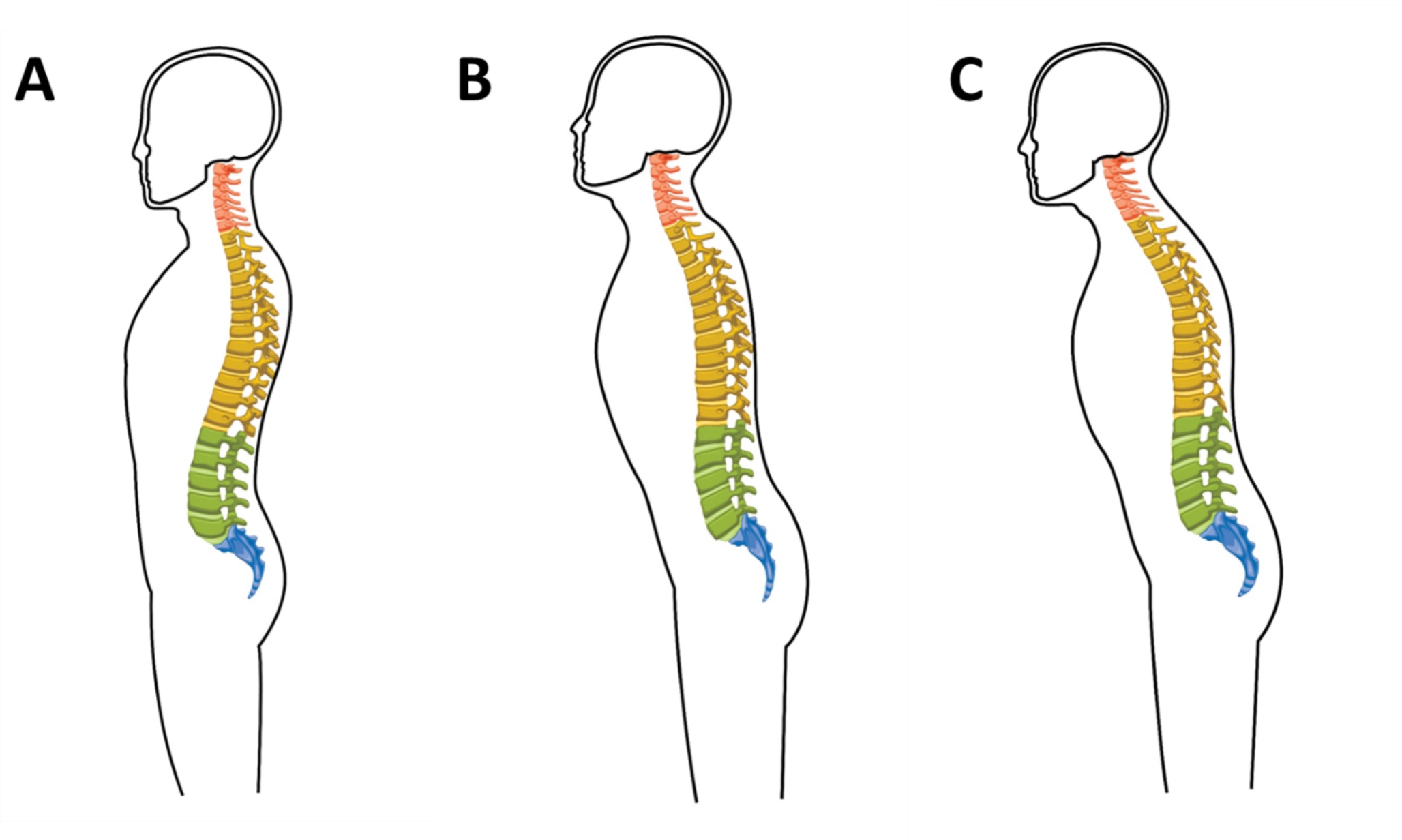 Correlation analysis of global sagittal alignment of the spine in cases of low-grade degenerative lumbar spondylolisthesis