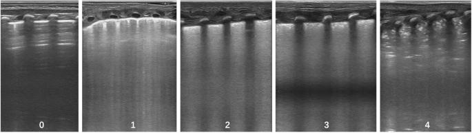 Accuracy of lung ultrasound in predicting successful extubation in preterm infants born ≤ 25 weeks