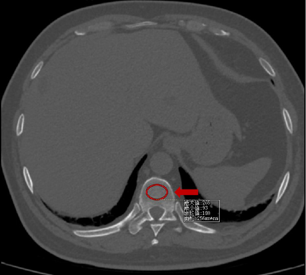 Associations of fat, bone, and muscle indices with disease severity in patients with obstructive sleep apnea hypopnea syndrome