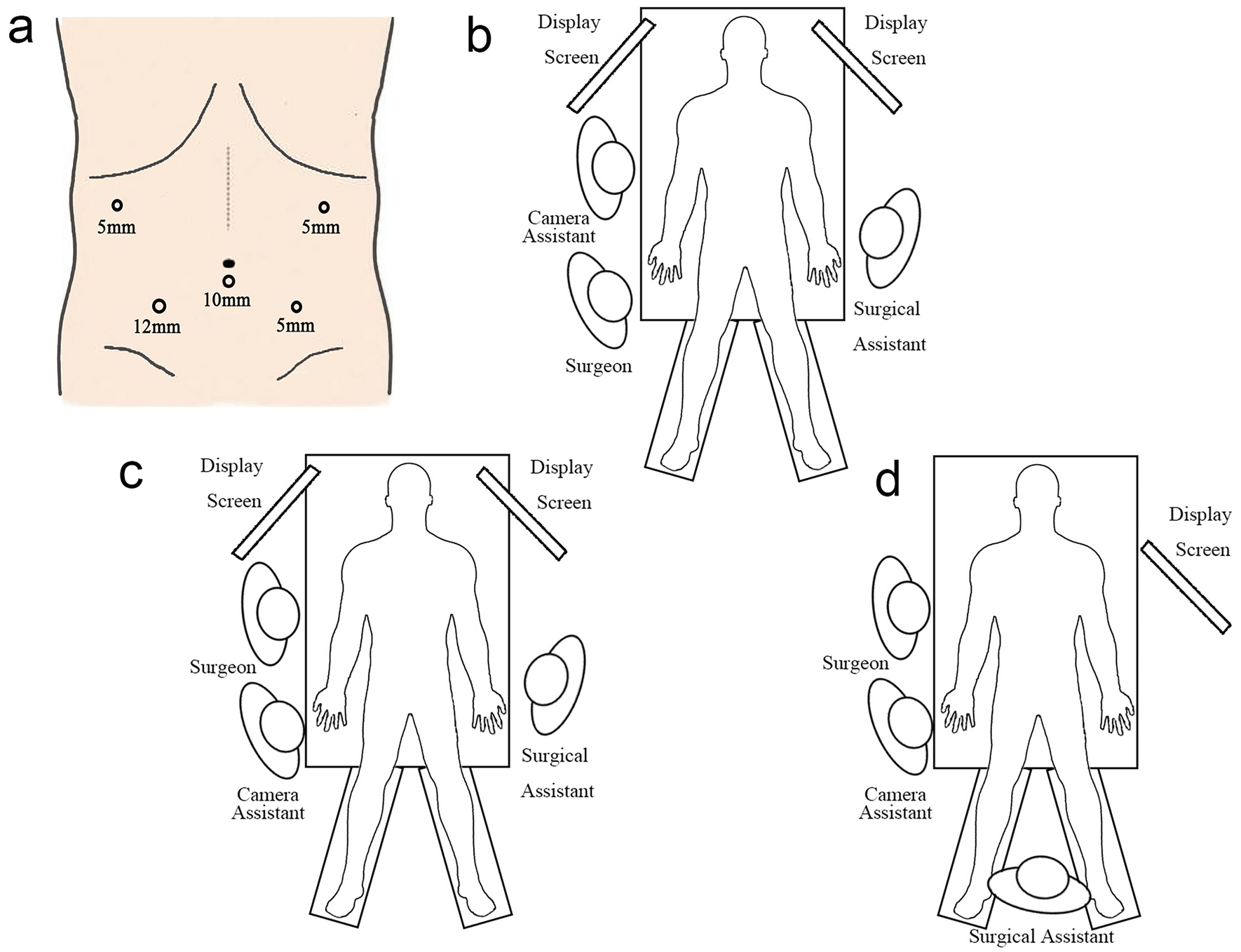 Pancreas-guided C-shaped surgical procedure: a safer and more efficient procedure for laparoscopic left hemicolectomy in obese patients