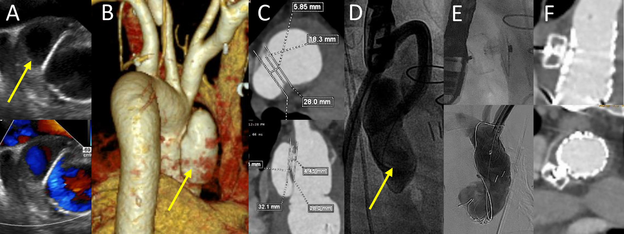 Aortic pseudoaneurysm closure by combination of LAA occluder and covered stent