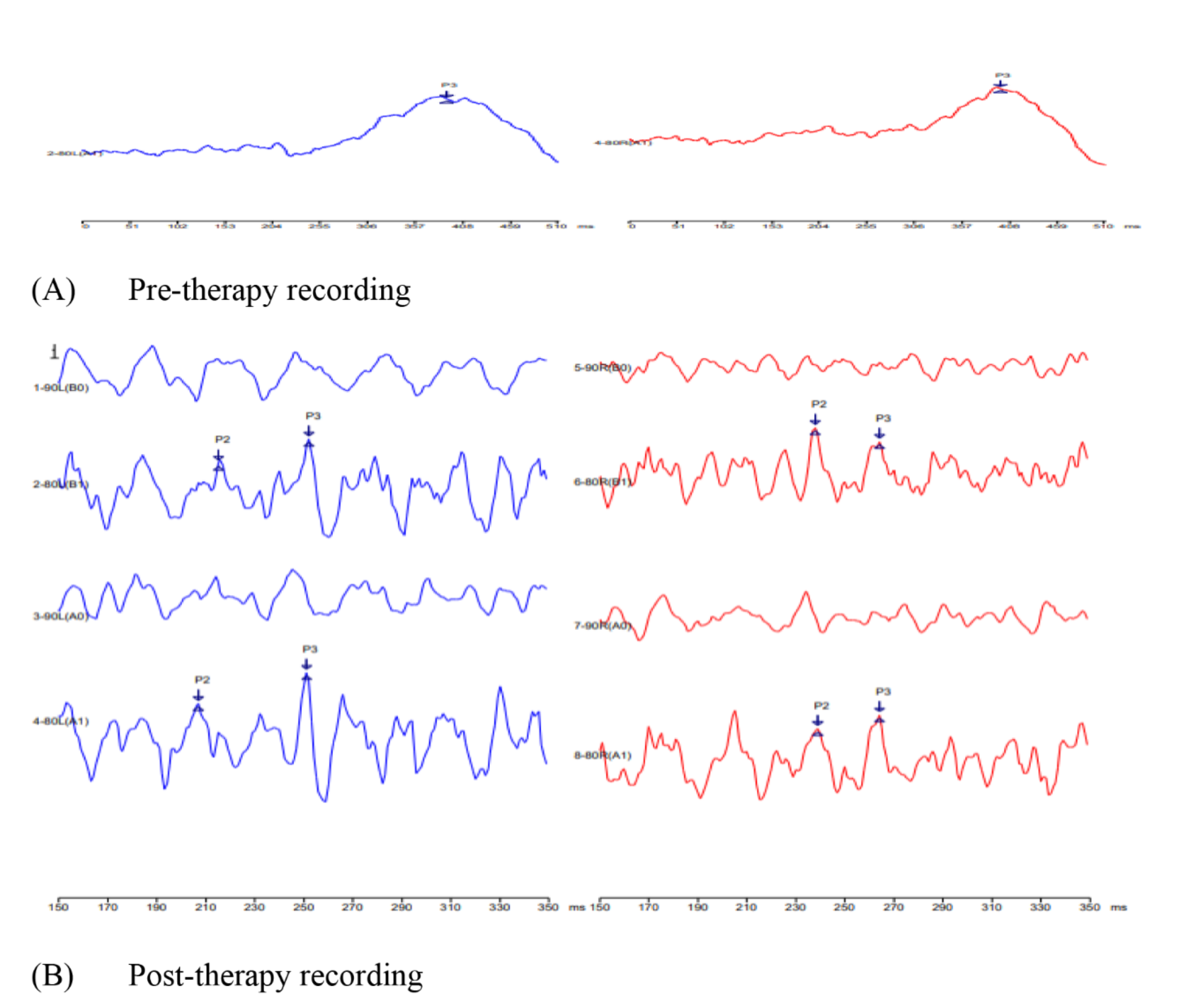 Exploring P300 Responses in Tinnitus: Linking Cognitive and Audiological Assessments