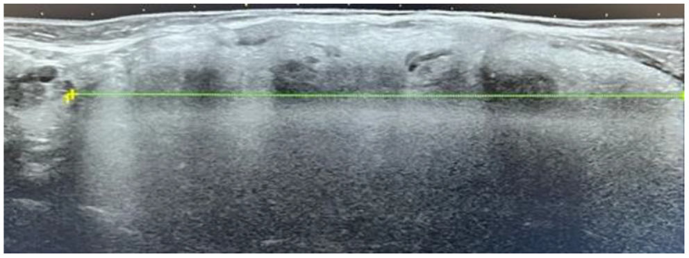 Diffuse Lipomatosis of the Thyroid Gland: A Rare Presentation and Diagnostic Challenge