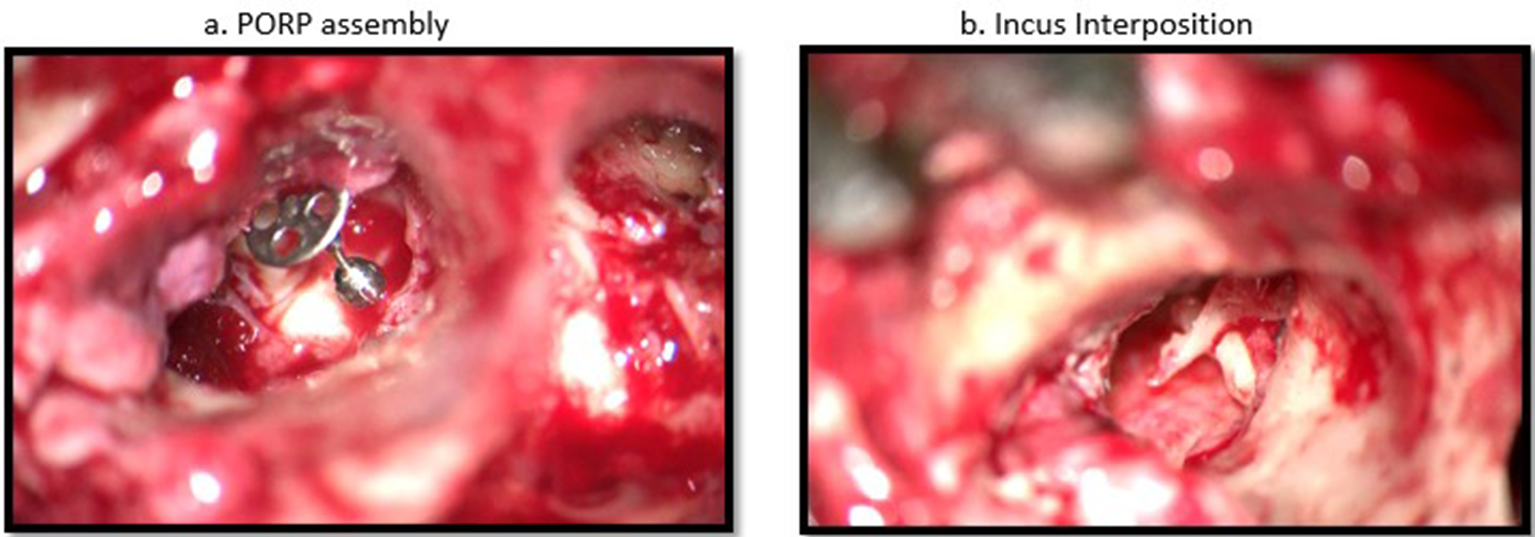 Optimizing Hearing Outcomes in Middle Ear Surgery: A Comparative Analysis of Titanium (PORP) Against Autologous Incus in Type IIb Tympanoplasty