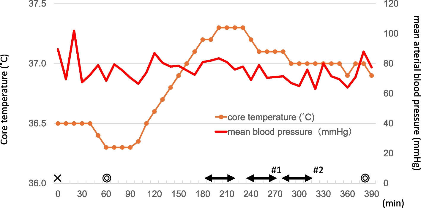 Intraoperative vascular anastomosis occlusion due to cold agglutinin disease during brain surgery: a case report