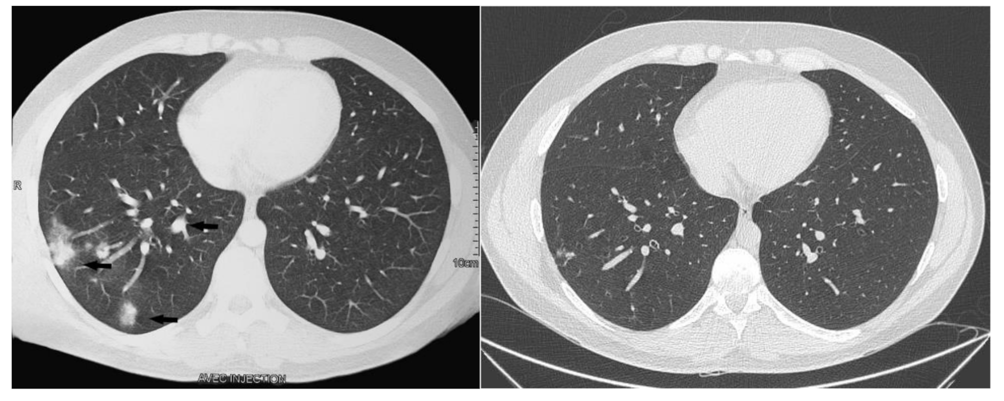 Persistent NK cell deficiency associated with pulmonary cryptococcosis