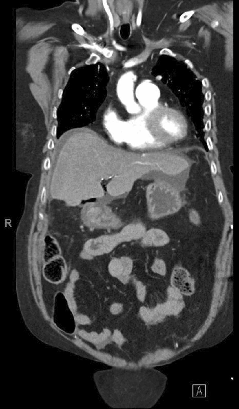 Surgical Management of Perforated Peptic Ulcers