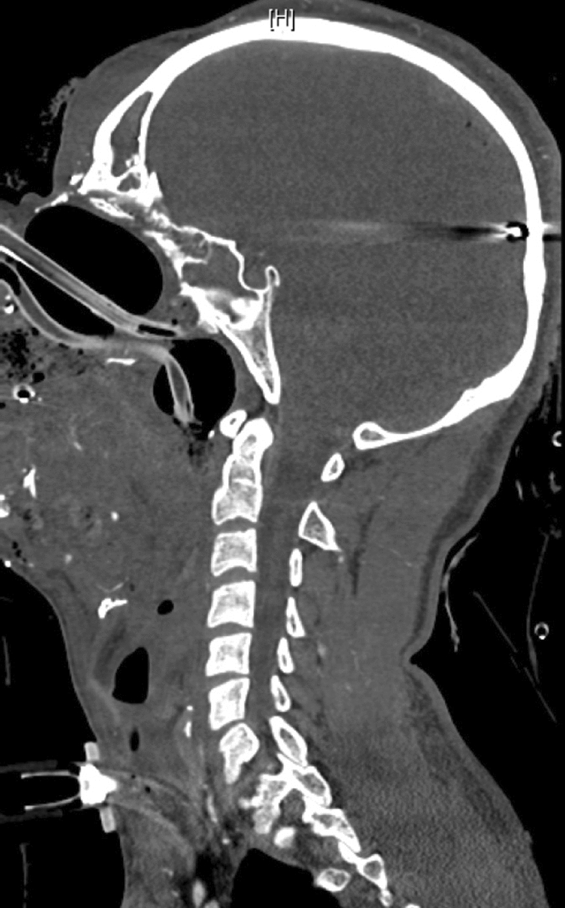 A Decadal Review of Reconstruction of Maxillofacial Gunshot Injuries and the Trajectory Forward