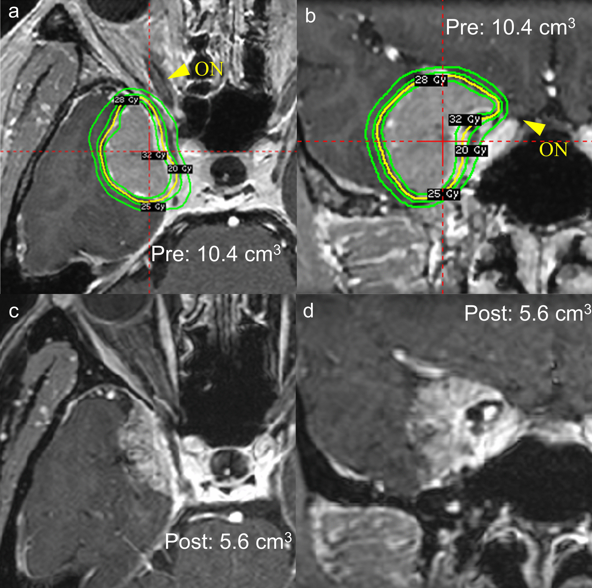 Effectiveness and safety of hypofractionated gamma knife radiosurgery for large meningiomas and those adjacent to the optic pathway and brainstem: preliminary therapeutic outcomes