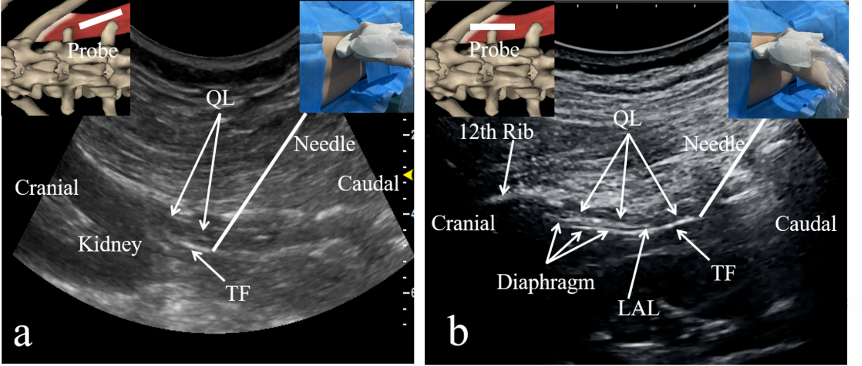 Modified versus traditional subcostal anterior quadratus lumborum block for postoperative analgesia after laparoscopic nephrectomy: a randomized-controlled study