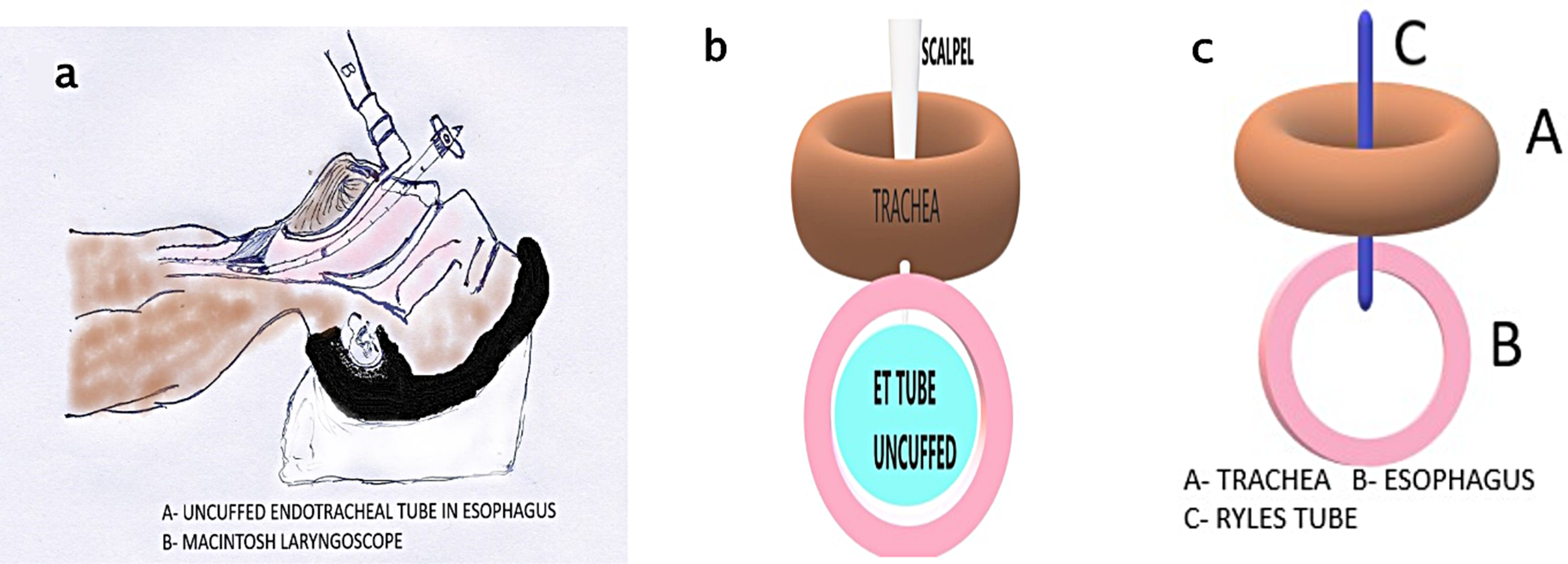 A Modified Technique for Secondary Tracheo-Esophageal Puncture– An Affordable Option