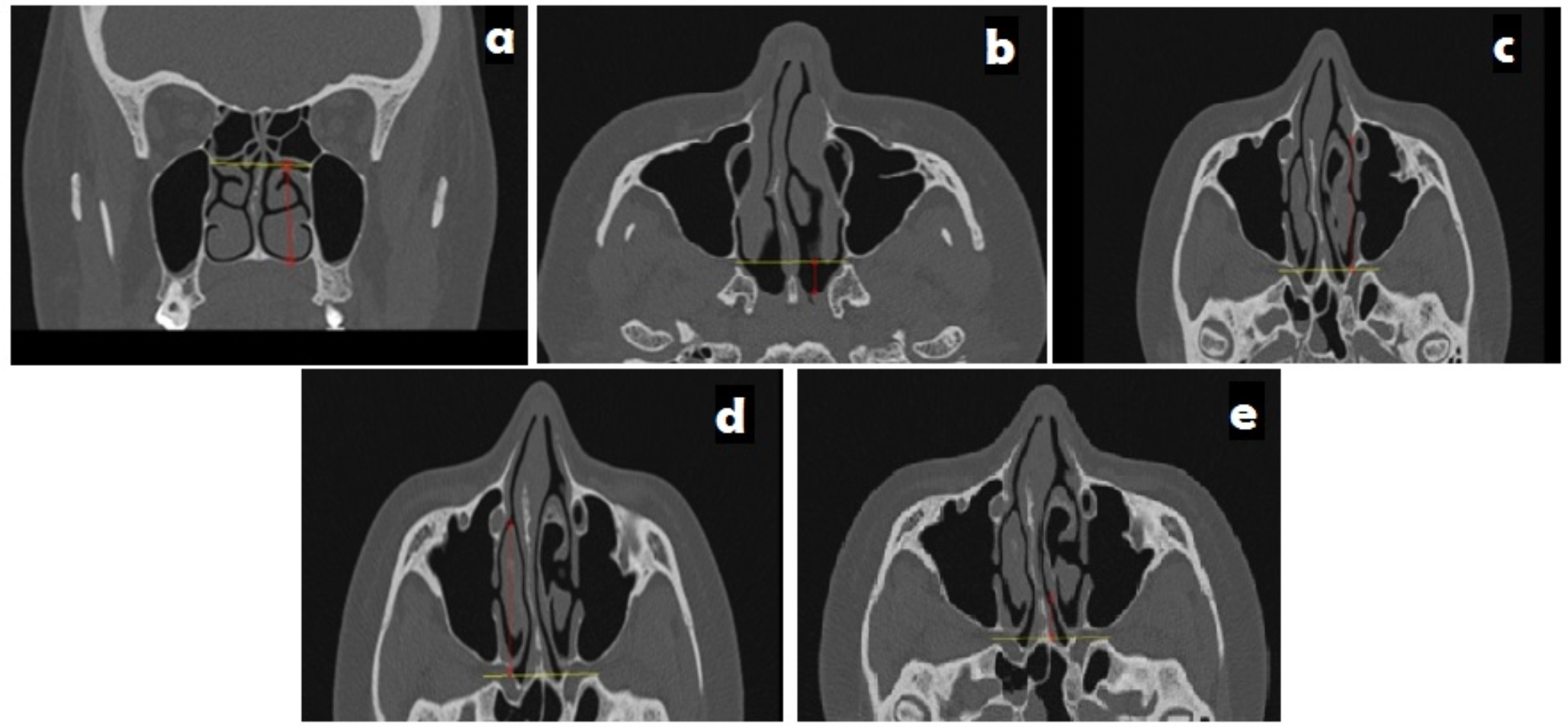 A Radiographic Morphometric Analysis for the Preoperative Localization of the Sphenopalatine Artery