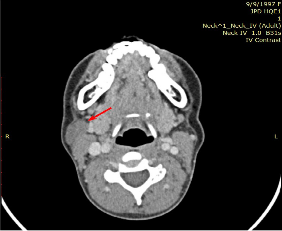 Masson’s Tumor as an Unexpected and Rare Cause of Neck Mass: a Case Report