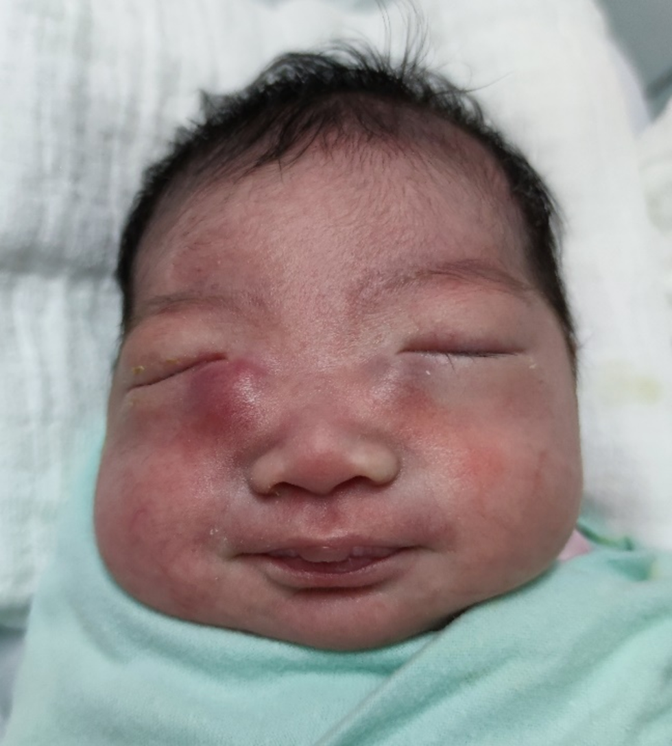 Double Pair of Eyes in Newborn: Bilateral Congenital Dacryocystocele– A Case Report