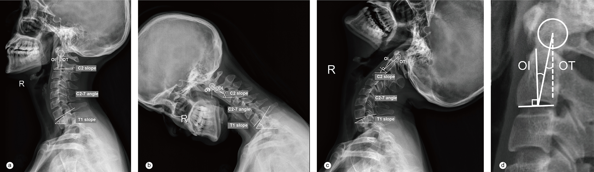 The effect of cervical spine flexion-extension motion on odontoid parameters