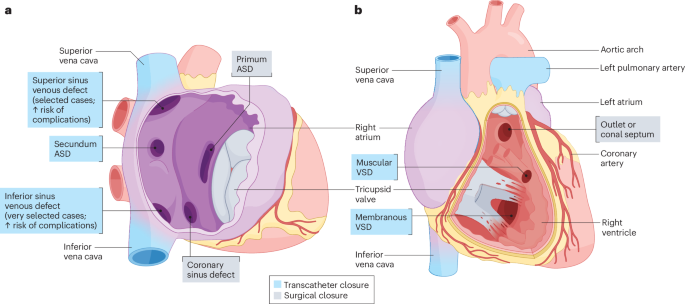 Interventions for adult congenital heart disease