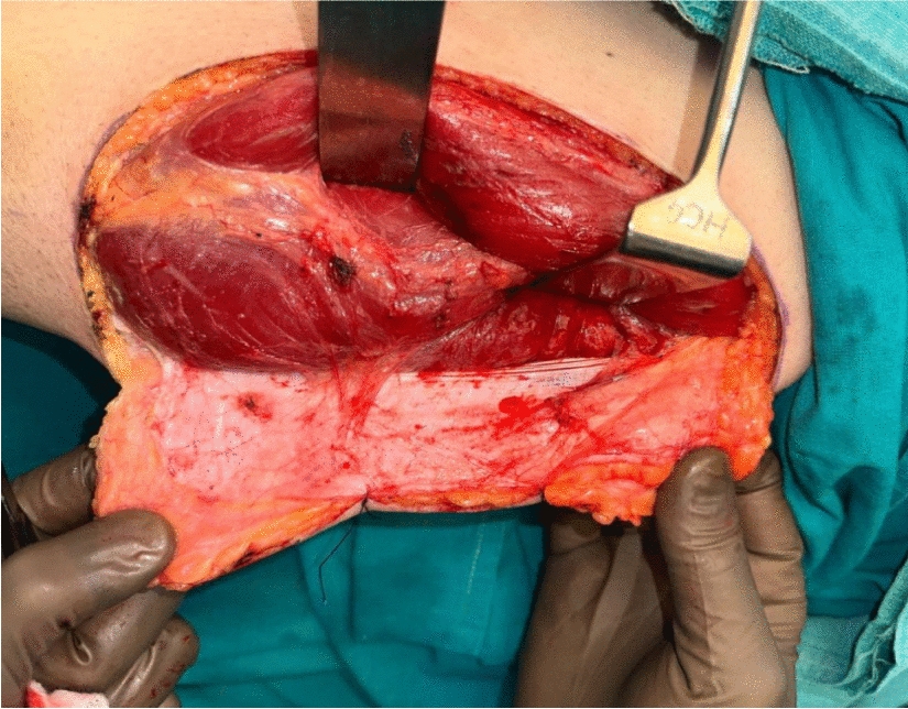 The Anteromedial Thigh Flap: A Surgical Savior for Challenging Perforator Anatomy