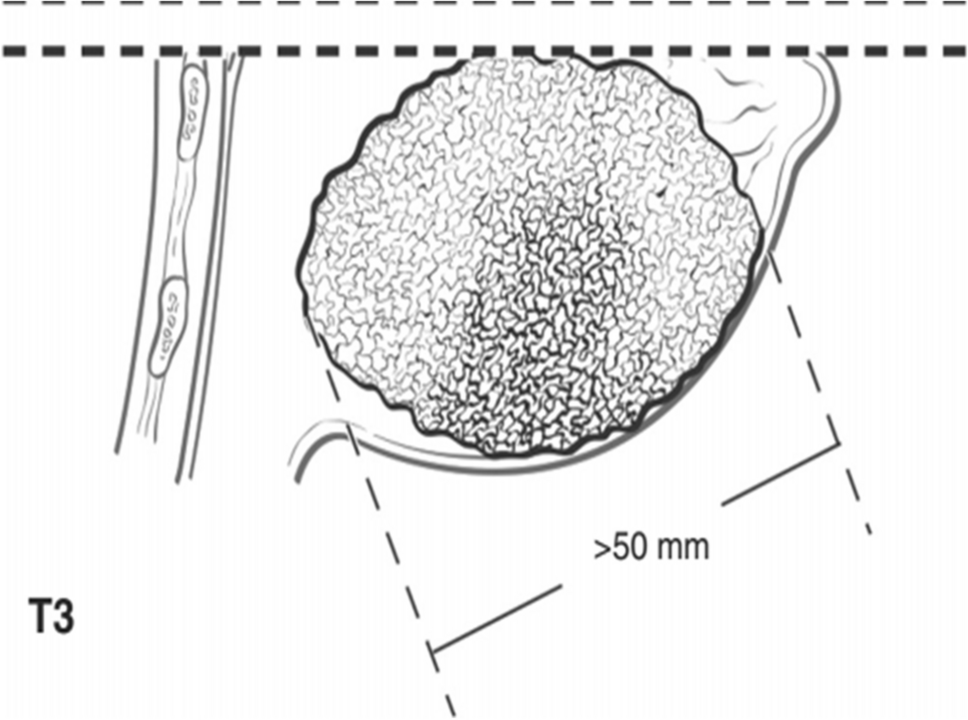 Asian Society of Mastology: ASOMA guide on Locally Advanced Breast Carcinoma