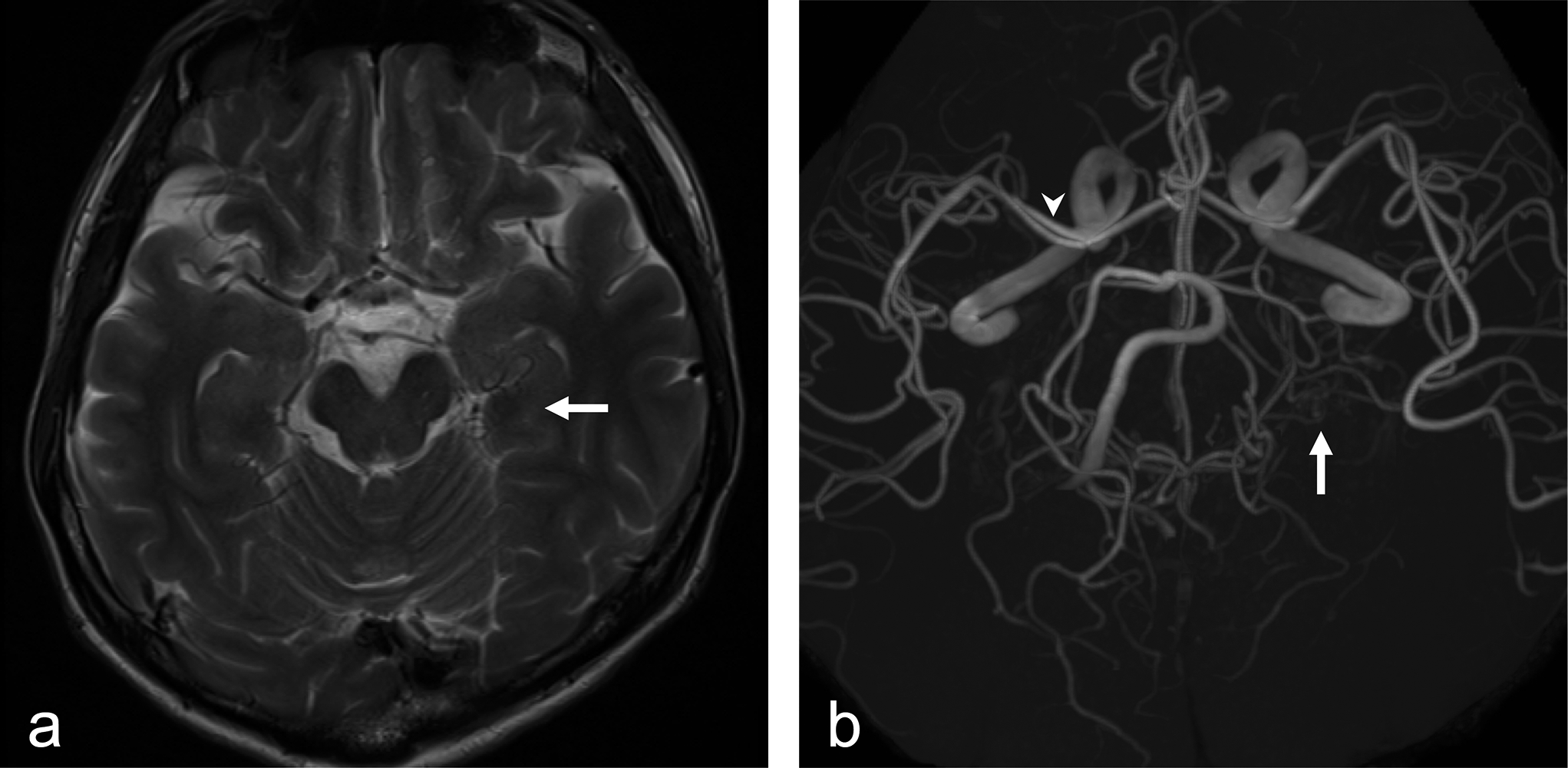 Accessory posterior cerebral artery as a duplicate anterior choroidal artery