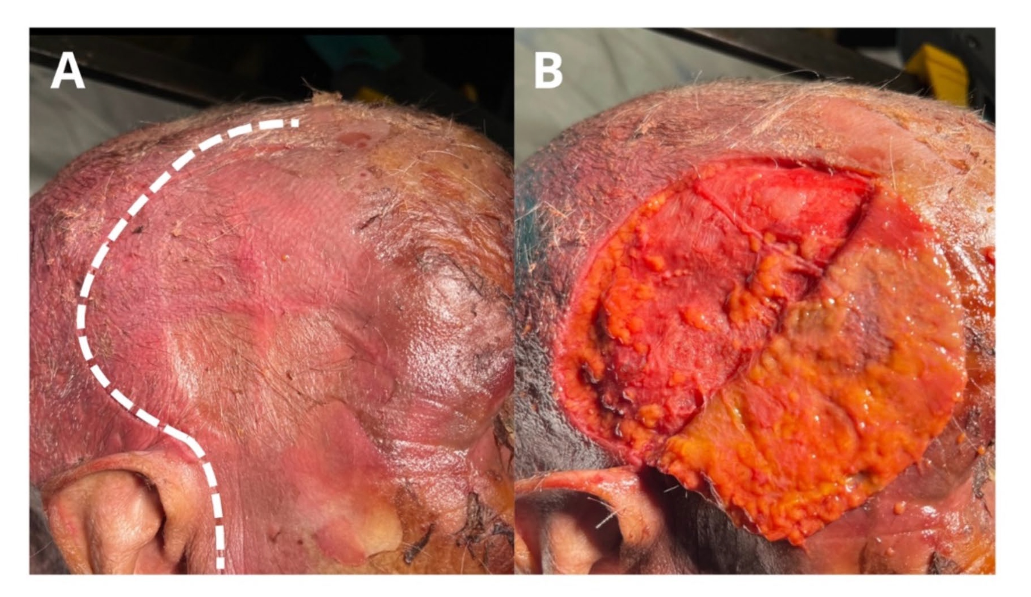 Viability of the temporoparietal fascia flap in closure of skull base defects. a radioanatomical study