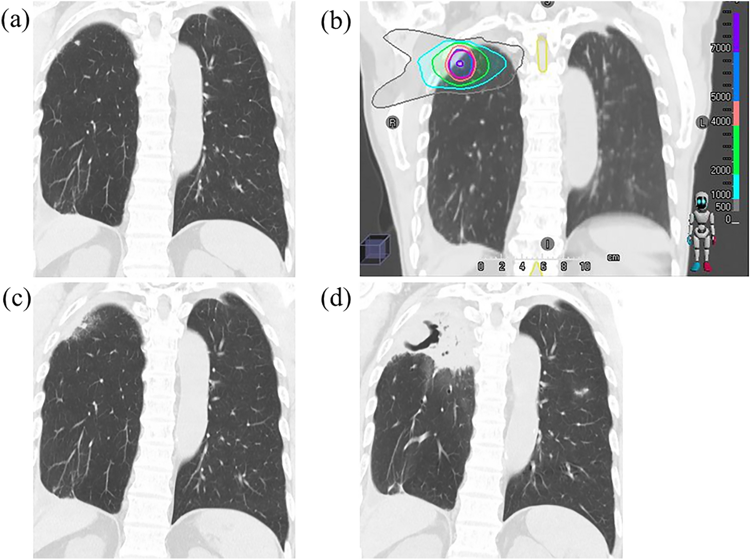 Chronic progressive pulmonary aspergillosis within the irradiated field after stereotactic body radiotherapy: two case reports