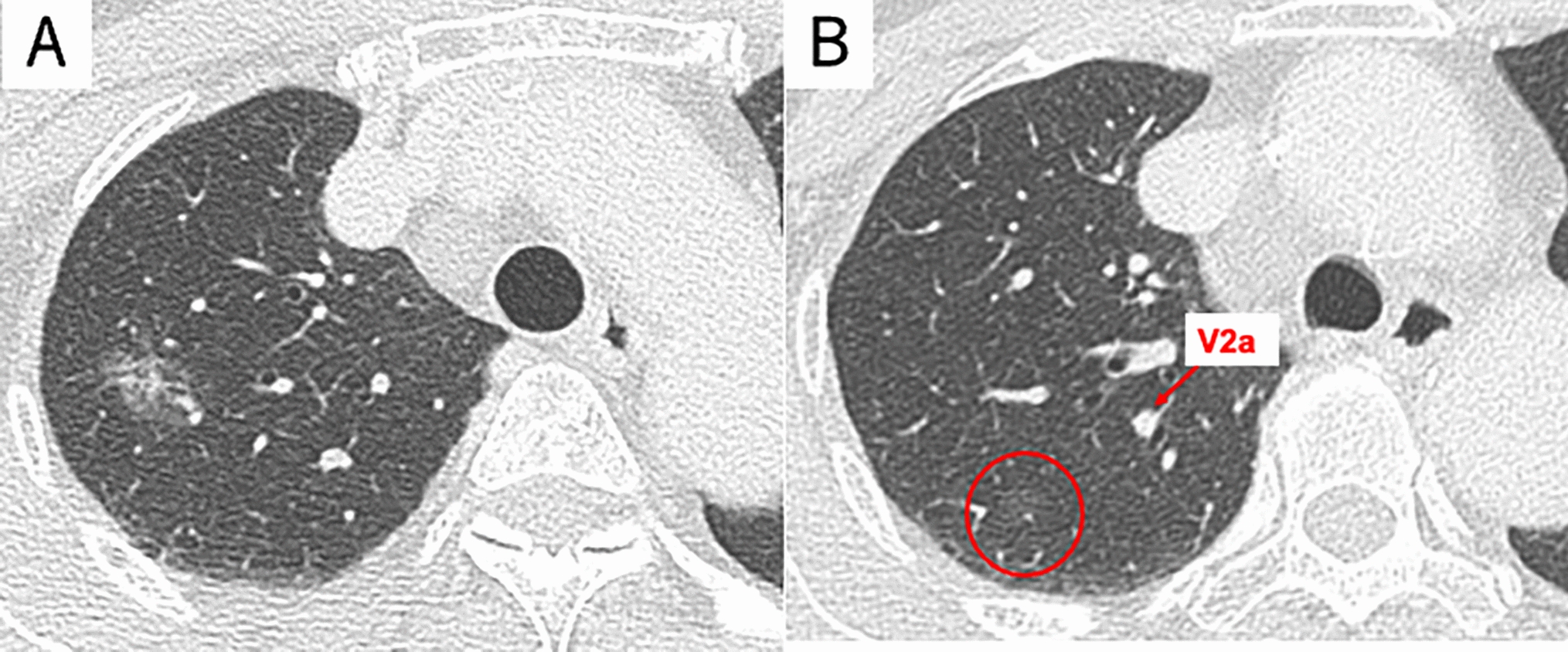 Thoracoscopic right apical segmentectomy in a patient with tracheal bronchus: a case report and review of literature