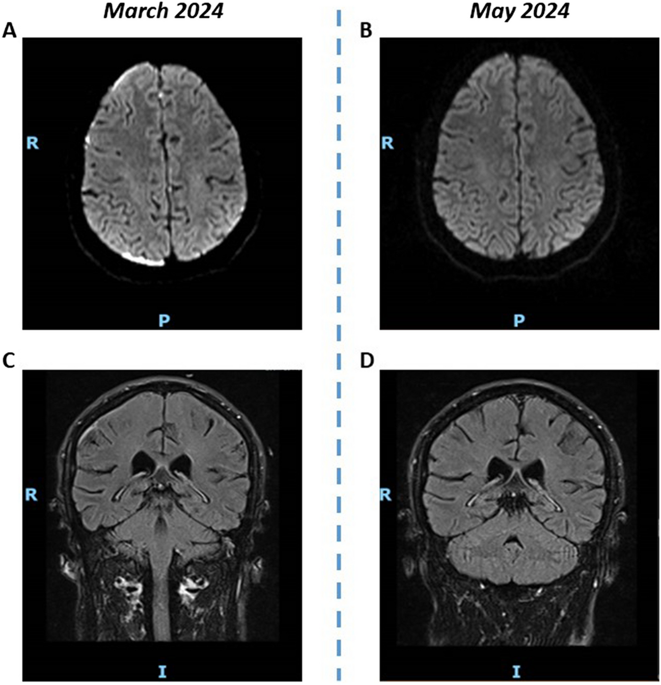 Rheumatoid meningitis: a challenging diagnosis for neurologists