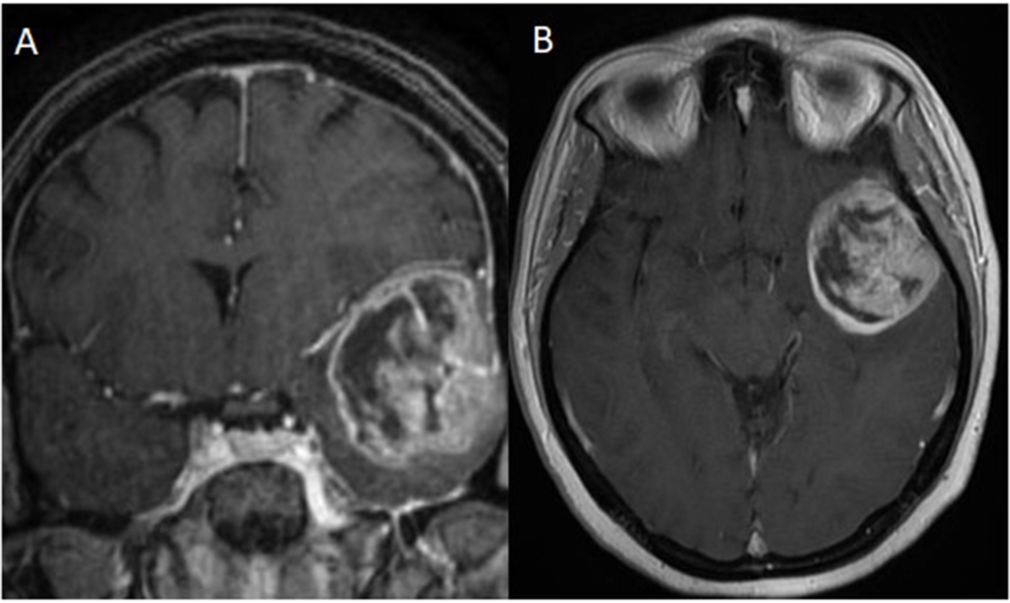 Effectiveness and safety of Perampanel in refractory status epilepticus: a case series