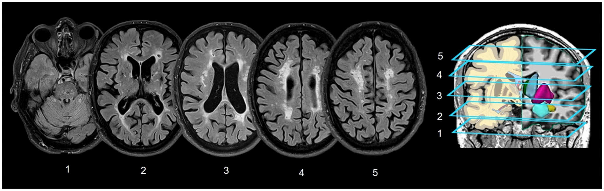 Challenges in diagnosing vascular parkinsonism: the pitfalls of an old tale