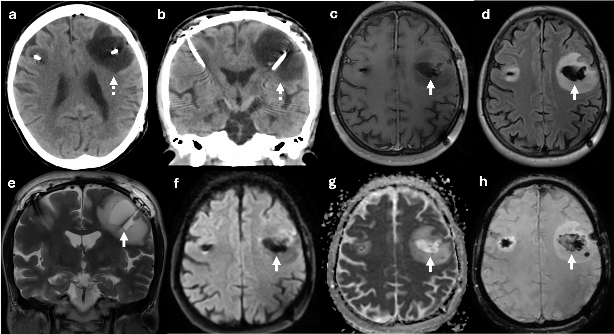 Hyperacute brain cyst after deep brain stimulation surgery: a case with complete spontaneous resolution