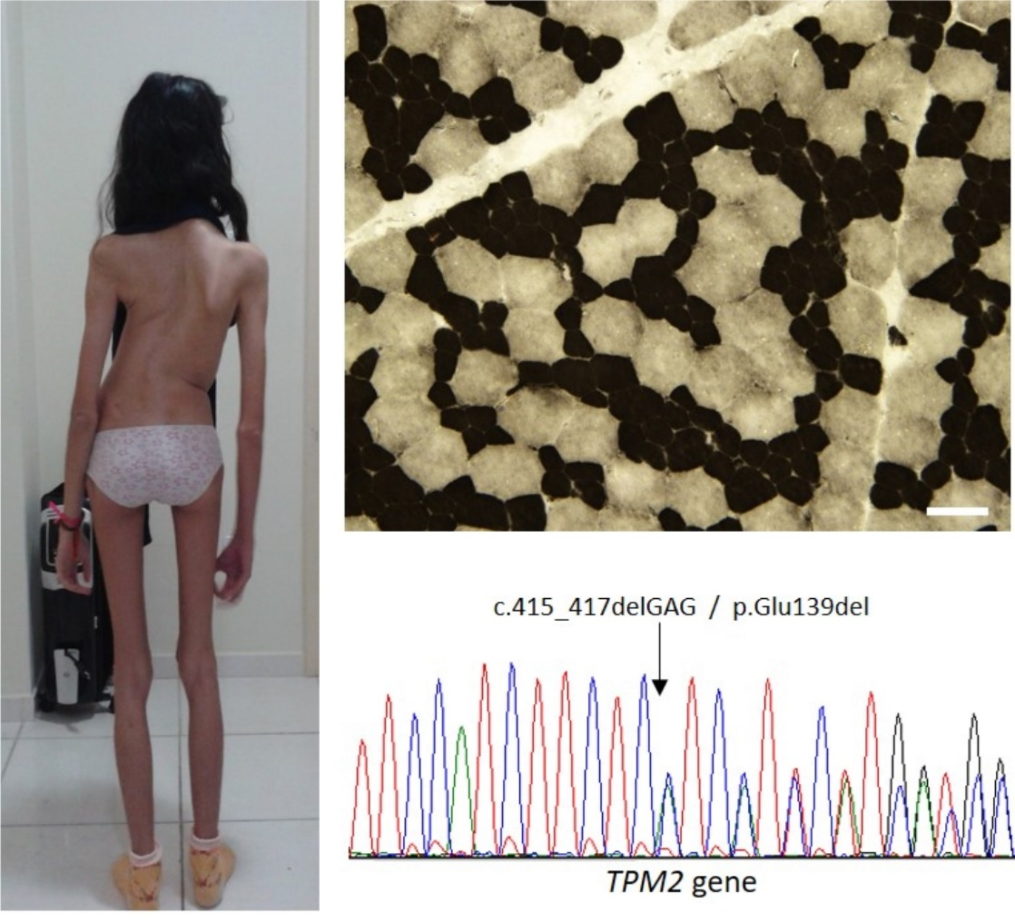 A TPM2 mutation causes congenital myopathy with fibre-type disproportion