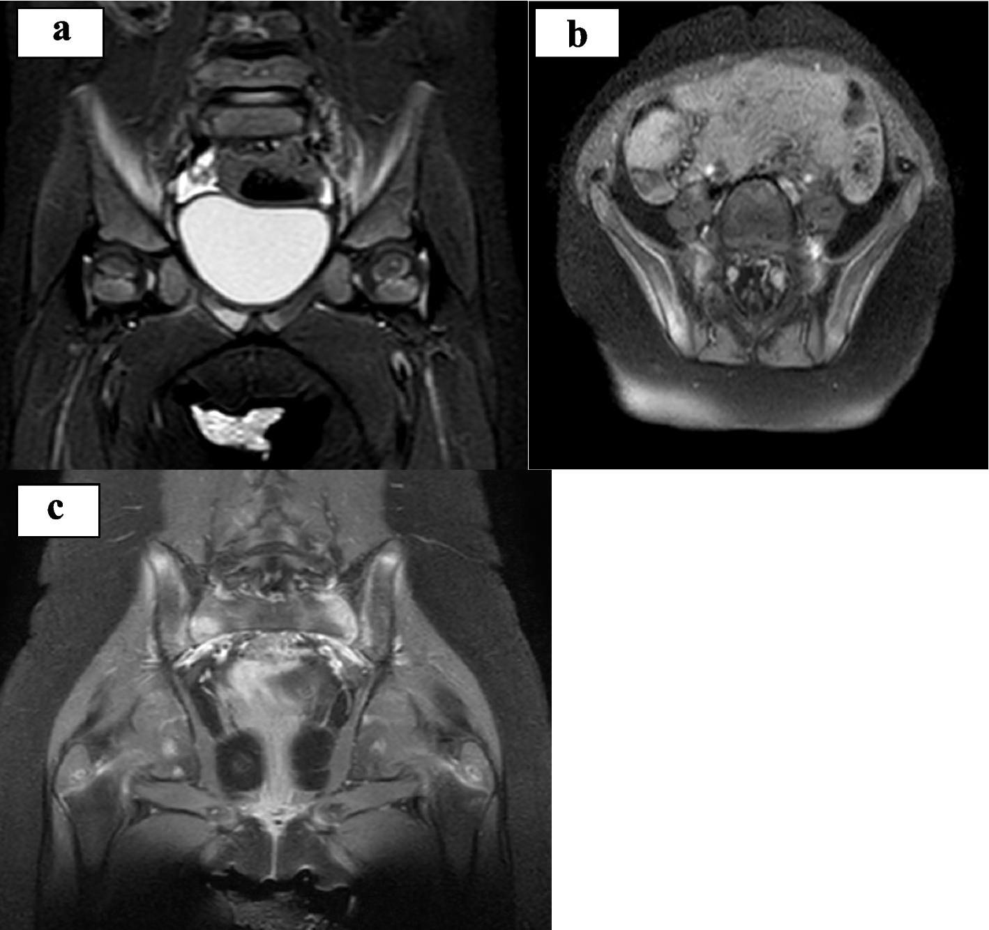 A child with Chronic Nonbacterial Osteomyelitis and celiac disease: accidental association or two different aspects of the same condition?