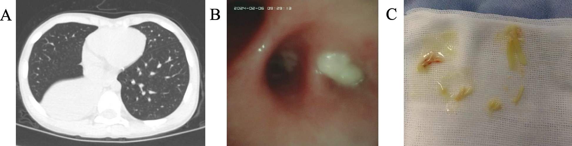 Characteristics of plastic bronchitis in children with infectious pneumonia