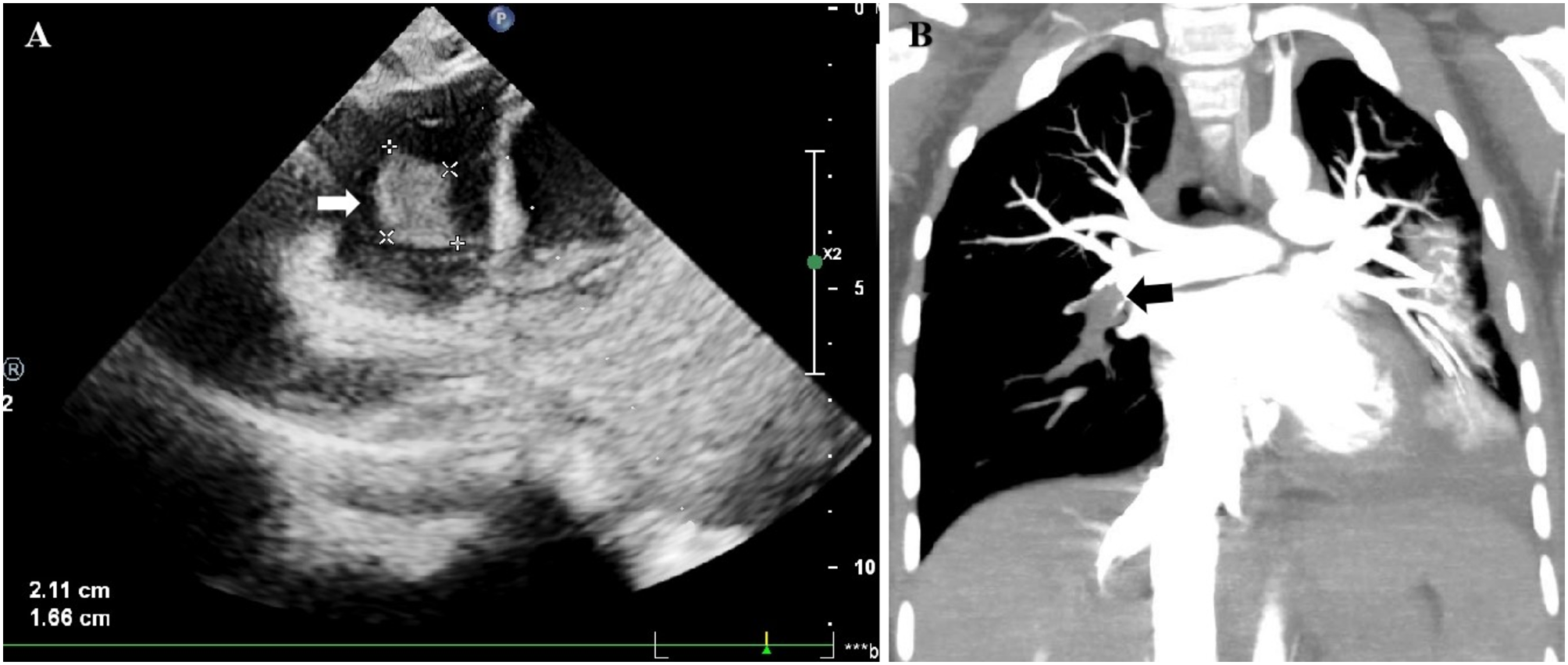 Clinical features of intracardiac thrombotic complication in patients with severe Mycoplasma pneumoniae pneumonia