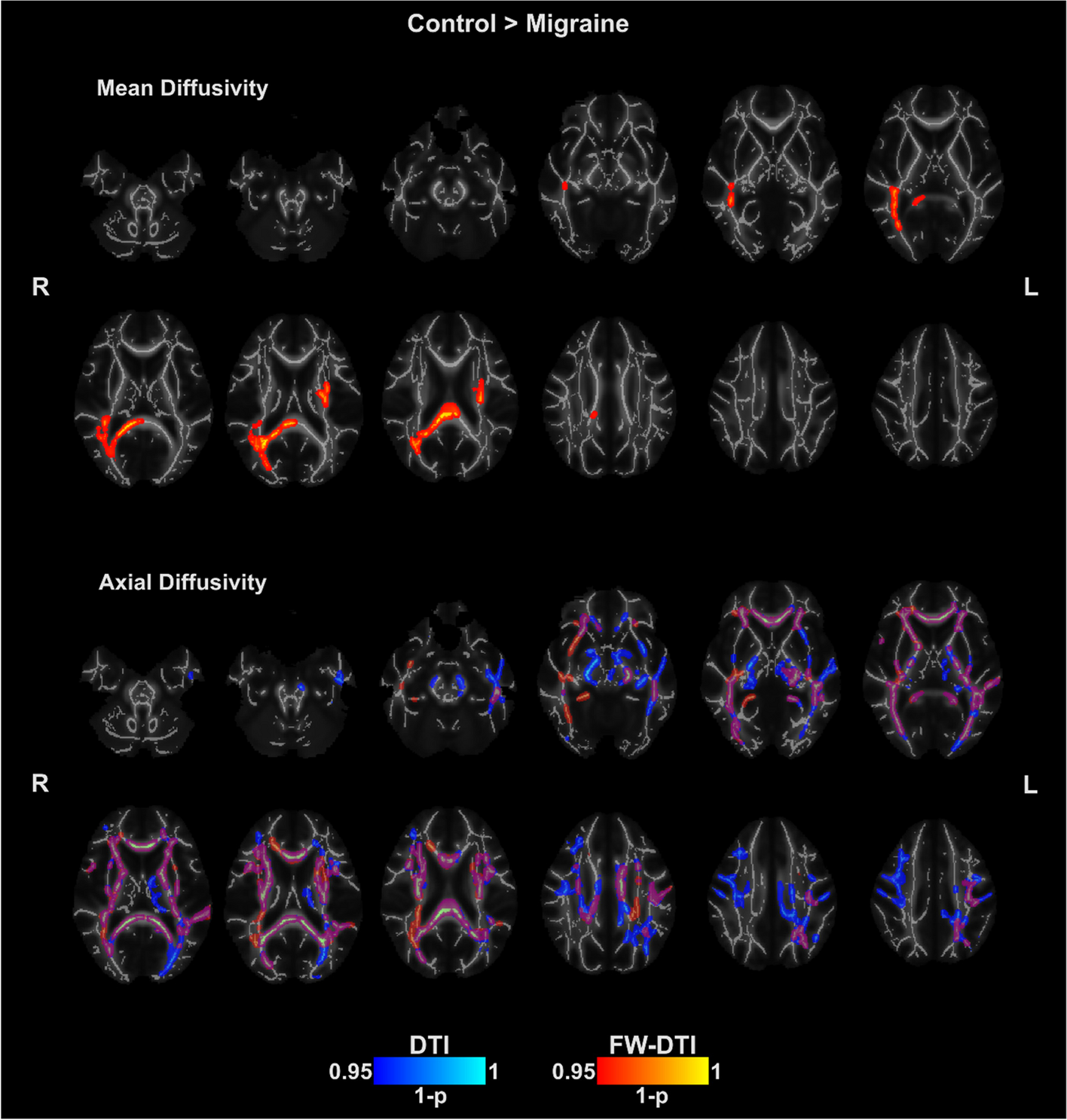 White matter alterations in episodic migraine without aura patients assessed with diffusion MRI: effect of free water correction