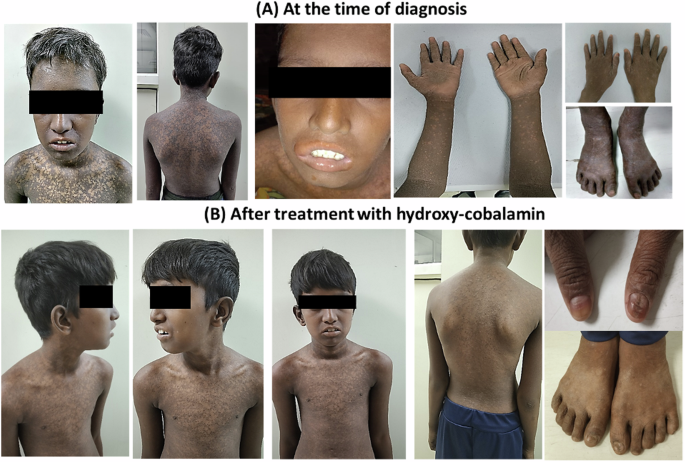 Phenotype puzzle: the role of novel LMBRD1 gene variant in Cbl deficiency causing Dyskeratosis Congenita-like clinical manifestations