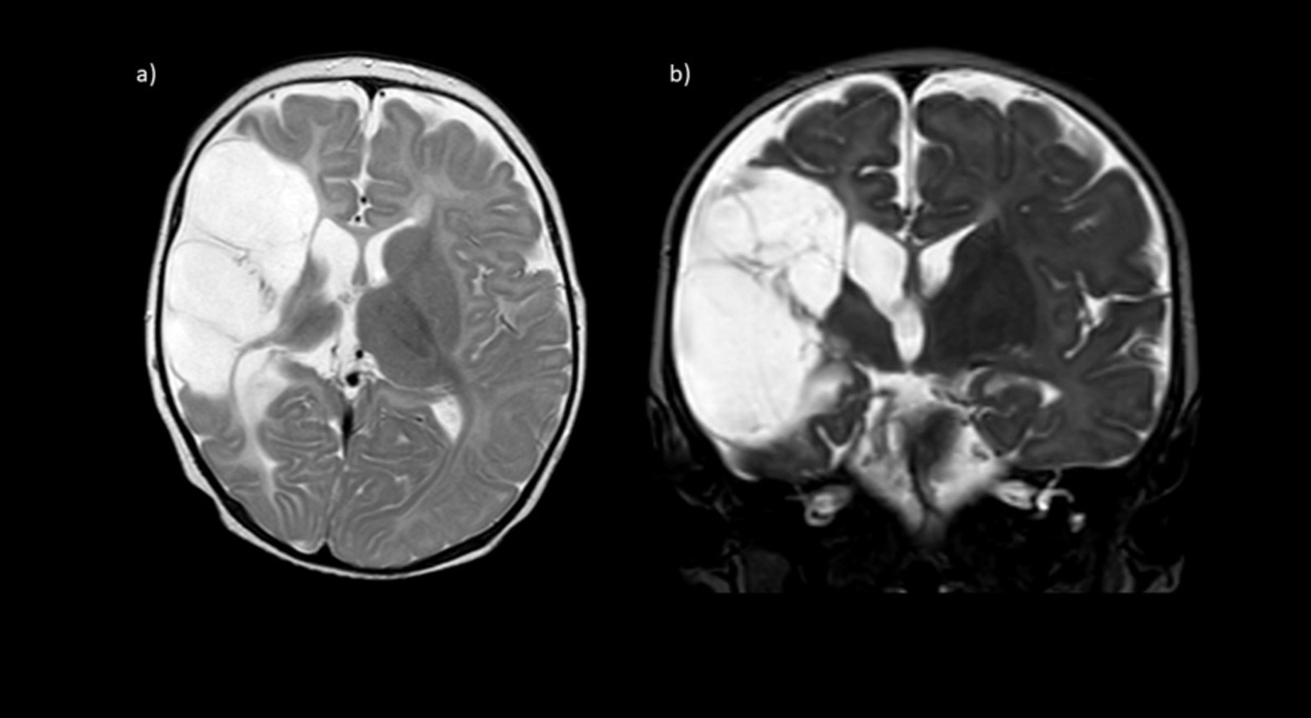 A case of atypical infantile de novo antiphospholipid syndrome presenting with neonatal ischemic stroke without any triggering risk factors as a “second hit” and review of the literature