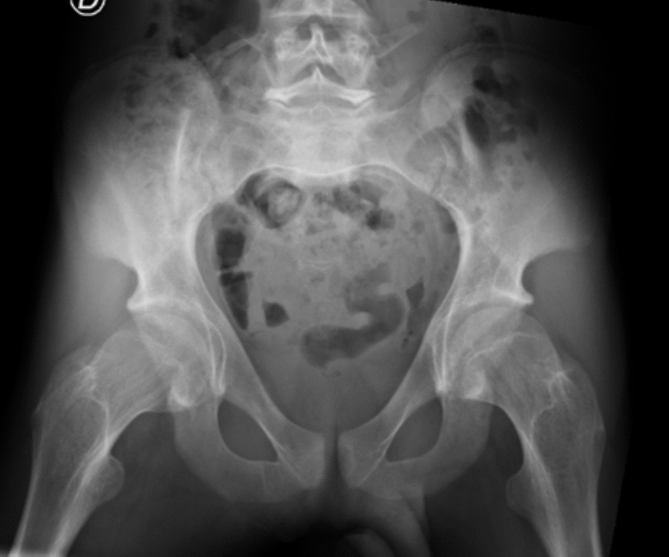 Severe Osteoporosis in an Adult Subject with RNU4-2 Gene Mutation