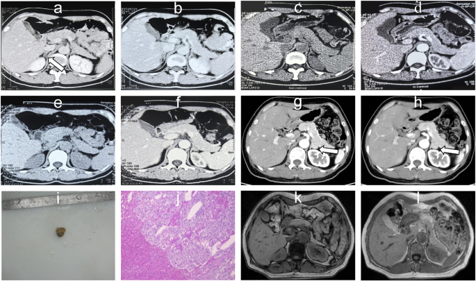 Recurrence of primary aldosteronism 20 years after surgery: a case report